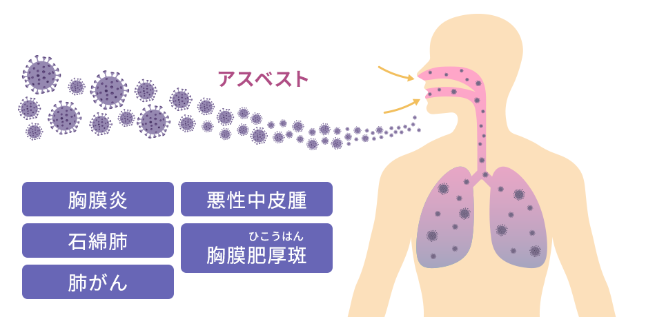 胸膜炎／悪性中皮腫／石綿肺／胸膜肥厚斑／肺がん